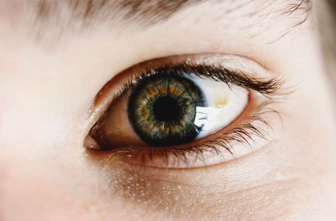 pinguecula sur l'oeil